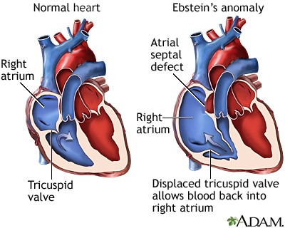 Ebstein's anomaly