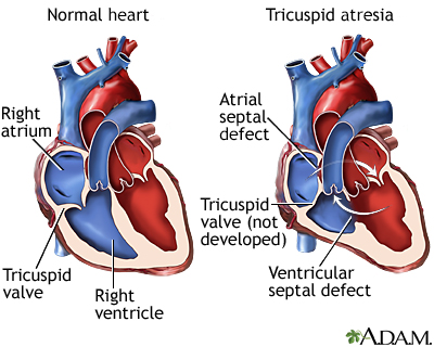 Tricuspid atresia