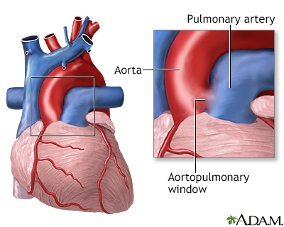 Aortopulmonary window