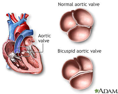 Bicuspid aortic valve