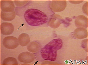 Mononucleosis - photomicrograph of cell