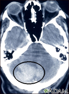 Intracerebellar hemorrhage - CT scan