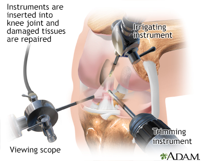 Knee arthroscopy