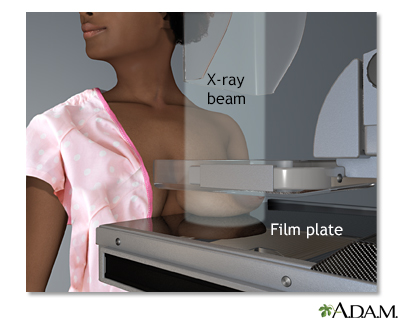 Mammogram