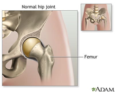 Hip joint replacement - Series