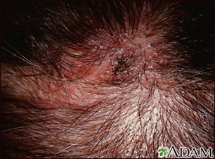 Ringworm, tinea capitis - close-up