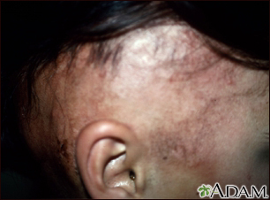 Alopecia, under treatment