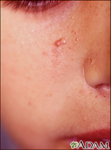 Tuberous sclerosis, angiofibromas  - face