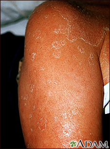 Exfoliation following erythroderma