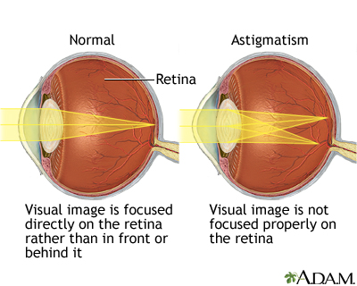 Astigmatism