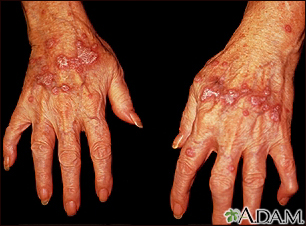 Lichen planus on the hands