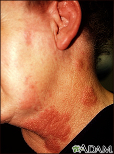 Herpes zoster (shingles) on the neck and cheek