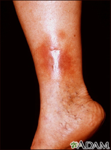 Dermatitis - stasis on the leg