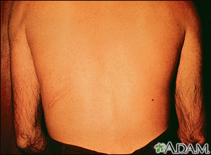 Strongyloidiasis, creeping eruption on the back