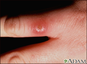 Leishmaniasis on the finger