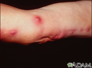 Sporotrichosis on the arm