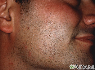 Molluscum contagiosum on the face