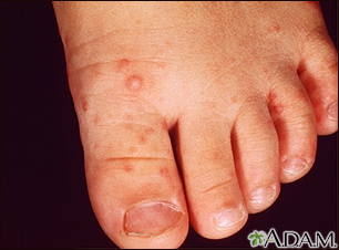 Hand, foot, and mouth disease on the foot