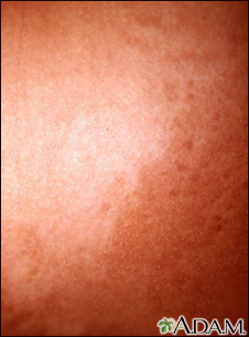 Hyperpigmentation 2