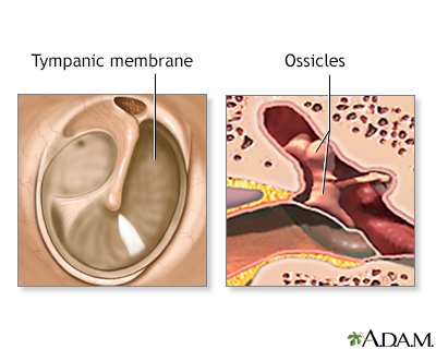 Eardrum repair - series