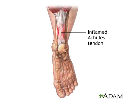 Inflamed Achilles tendon