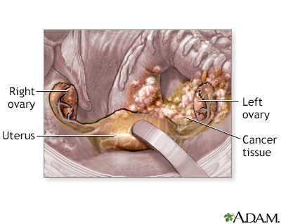 Ovarian cancer