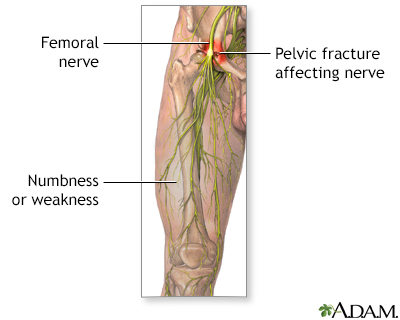 Femoral nerve damage