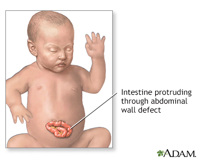 Infant abdominal hernia (gastroschisis)