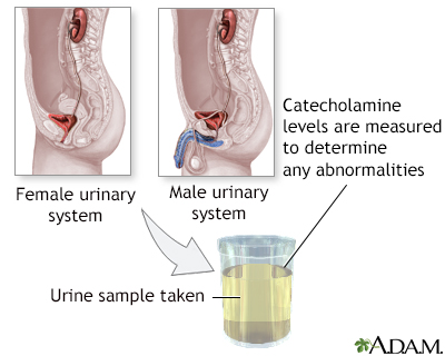 Catecholamine urine test