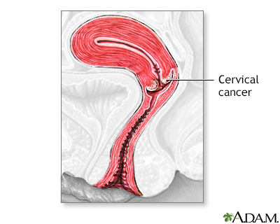 Cervical cancer