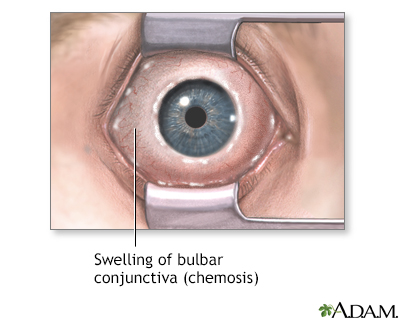 Chemosis