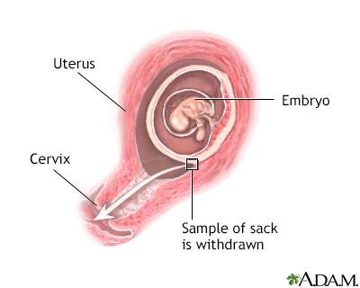 Chorionic villus sampling