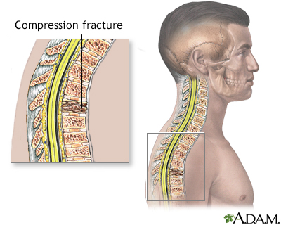 Compression fracture