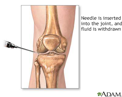 Joint aspiration