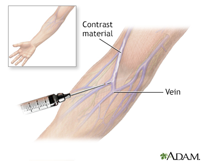 Intravenous pyelogram