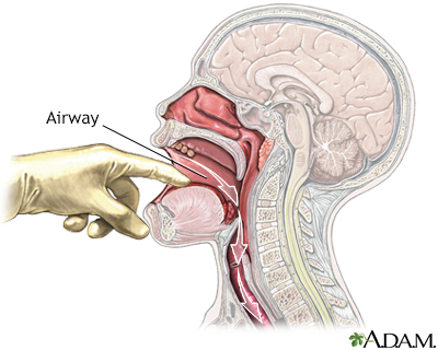 Check airway