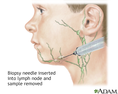 Lymph node culture