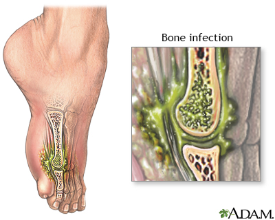 Osteomyelitis