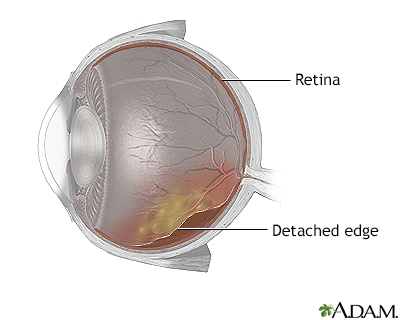 Detached retina