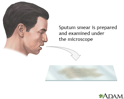 Sputum test