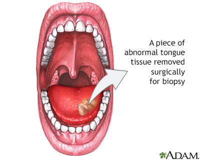 Tongue biopsy