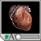 Tachycardia