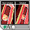 Tobacco use - effects on arteries