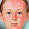How to treat a sunburn