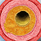 Hardening of arteries