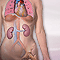 Systemic lupus erythematosus