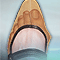 Foot pain