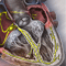 Atrial fibrillation