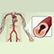 Atherosclerosis causes