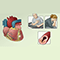 Angina pectoris treatment